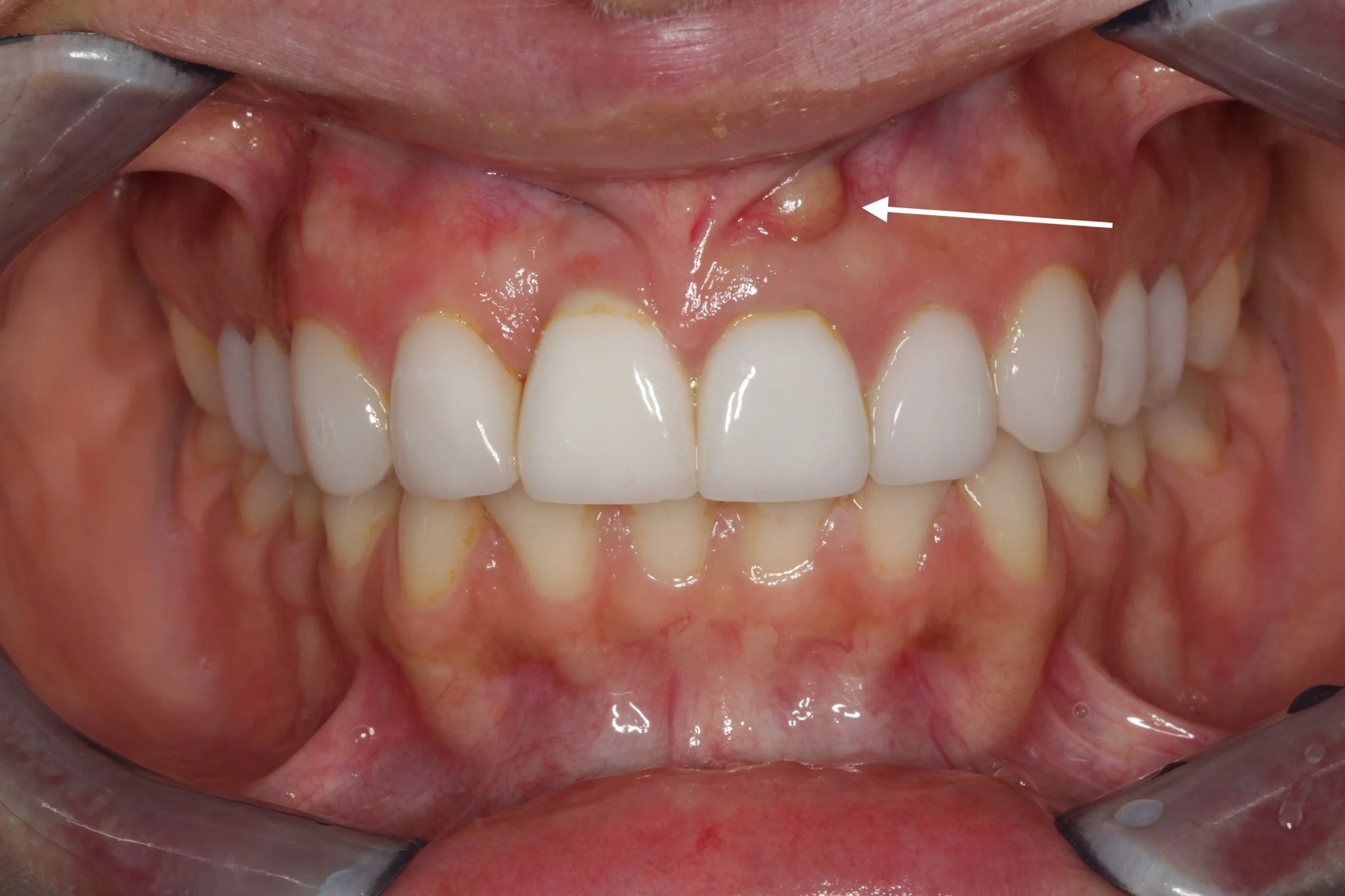 What a Dead Tooth Looks Like - Signs and Symptoms To Look Out For ...